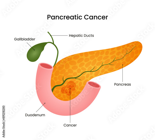 Symptoms of Pancreatic Cancer Disease