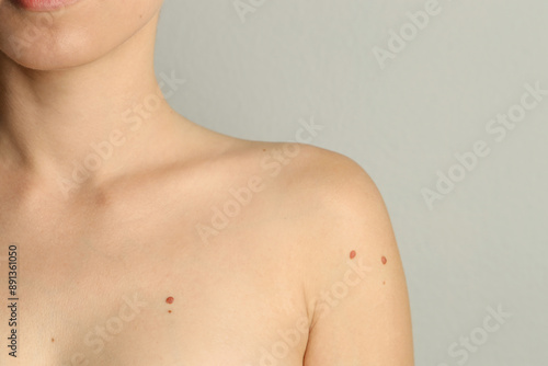 Woman with moles on her skin against light grey background, closeup. Space for text