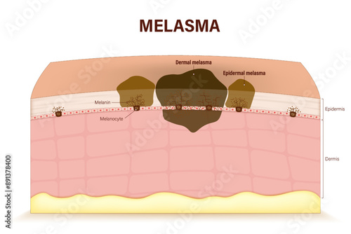 Melasma vector. Epidermal and dermal melasma. Facial skin problems. Human skin with hyperpigmentation.