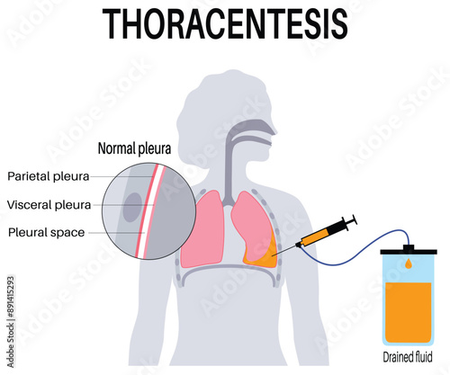 Thoracentesis Procedure Medical Poster: Chest Wall Incision for Fluid Removal, Unhealthy Lungs, Respiratory System Disease Vector Illustration