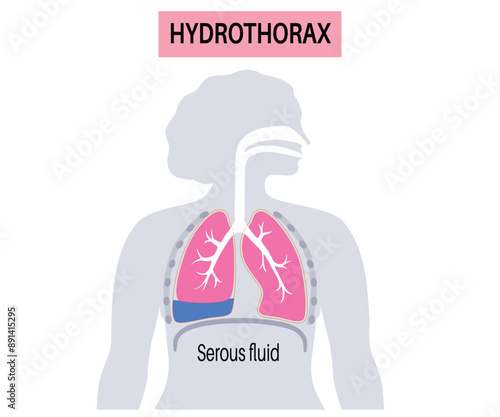 Hydrothorax Medical Illustration - Serous Fluid Accumulation in the Lung, Respiratory System Disease