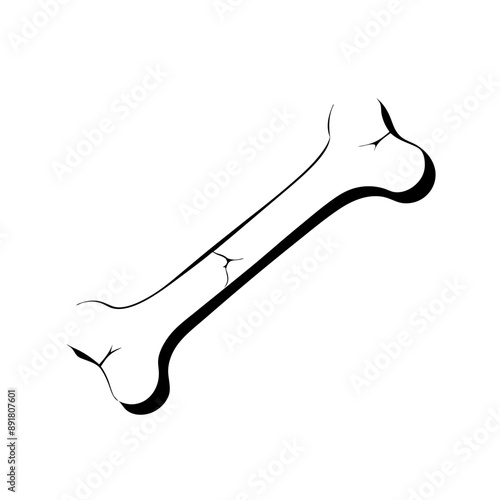 Illustration of broken bone demonstrating different types of fractures