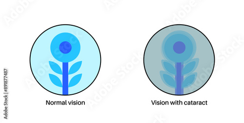 Cataract eye disease
