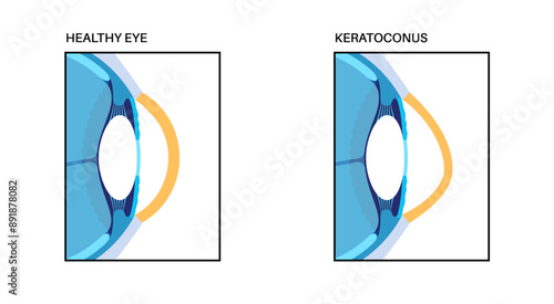Cataract eye disease