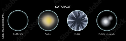 Cataract eye disease