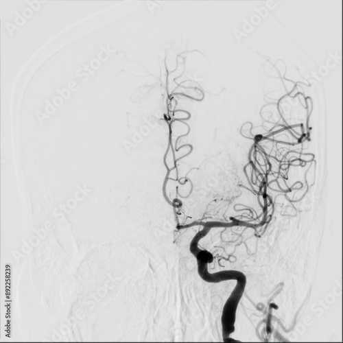 Cerebral angiography is a specialized procedure to visualize the arteries and veins in the brain for medical diagnosis. photo