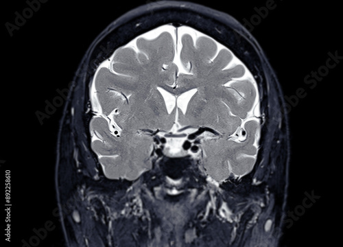 MRI  brain scan  Coronal T2W  for detect  Brain  diseases sush as stroke disease, Brain tumors and Infections. photo