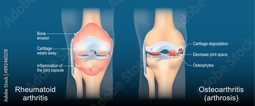 Rheumatoid arthritis and Osteoarthritis. Comparison between a Arthrosis and  RA joints