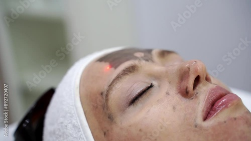 A beauty spa offers a laser facial treatment. Light. A woman undergoes a rejuvenating peel with a carbon mask, promoting skincare and reducing pigmented lesions. Female face cosmetic
