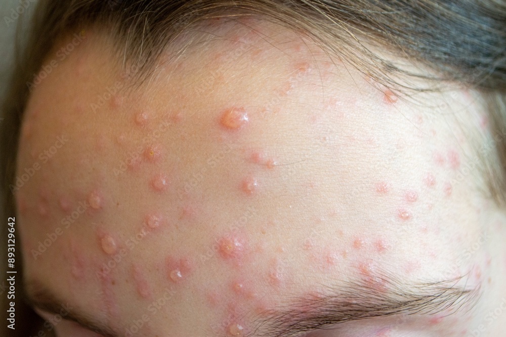 Varicella virus or Chickenpox bubble rash on child Varicella virus or Chickenpox bubble rash on child