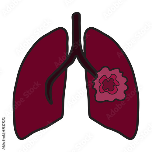 lung cancer 