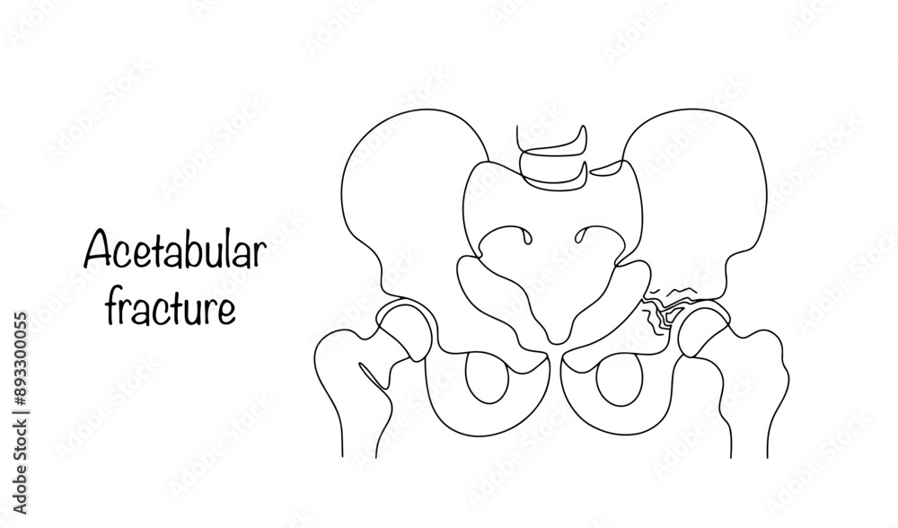 Acetabular fracture Acetabular fracture