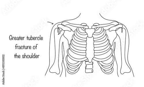 Shoulder fracture