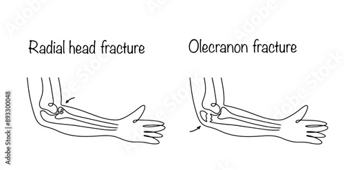 Arm fractures