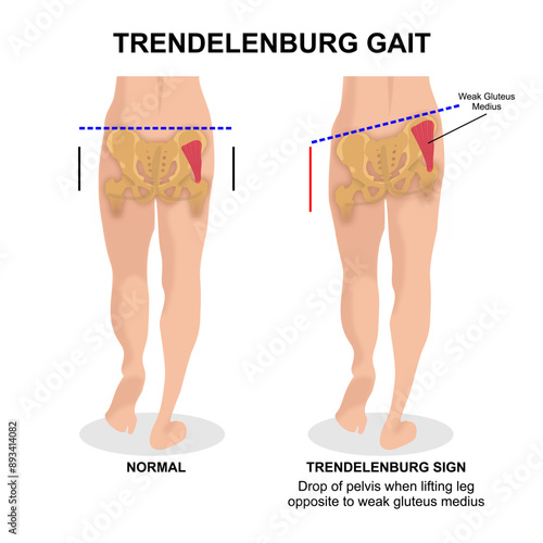 Trendelenburg Gait misaligned hip illustration