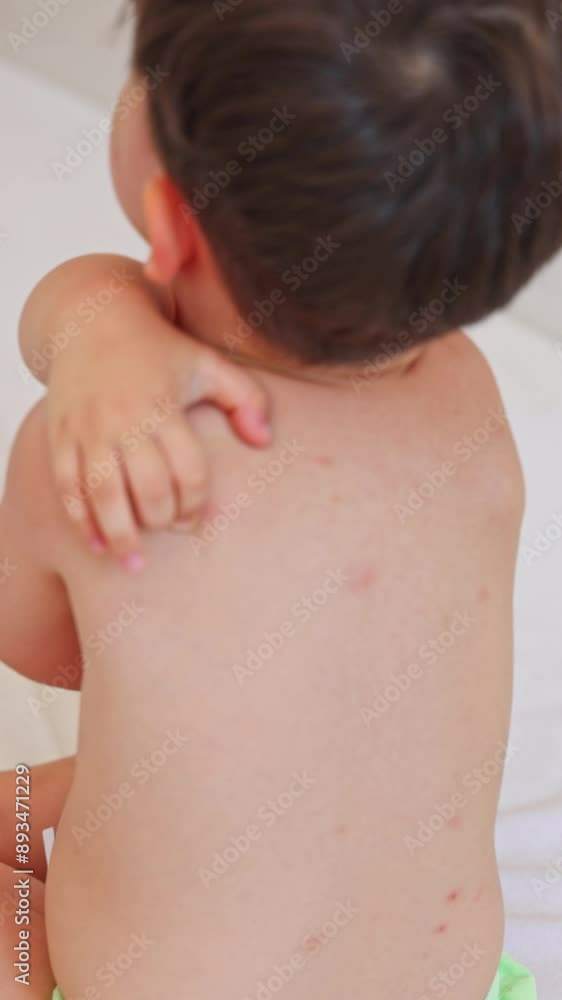 kid with lot of insects, mosquito, fleas or other parasites bites on body, back and legs.child scratches bug bites.lying baby boy toddler on pillow,covered with blanket.woman applying cream. kid with lot of insects, mosquito, fleas or other parasites bites on body, back and legs.child scratches bug bites.lying baby boy toddler on pillow,covered with blanket.woman applying cream.