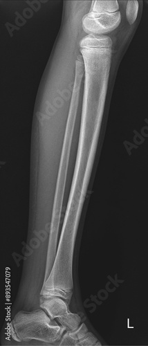 Tableau sur toile Lower limb tibia fibula lateral radiograph