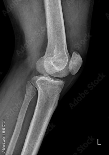 x ray image of a knee