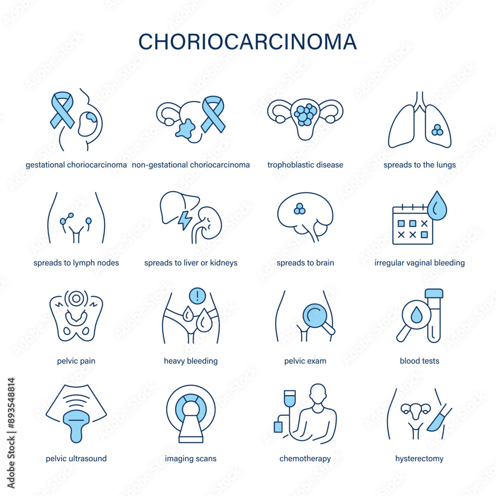 CHORIOCARCINOMA MEDLINEPLUS MEDICAL ENCYCLOPEDIA visual data 2