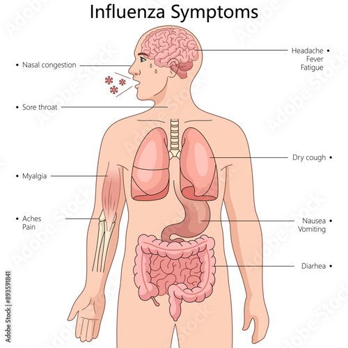 symptoms of influenza in different parts of the human body diagram hand drawn schematic vector illustration. Medical science educational illustration