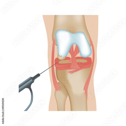 Arthroscopy of the knee joint. Surgery or diagnosis using a puncture with an arthroscope. Medical vector illustration.