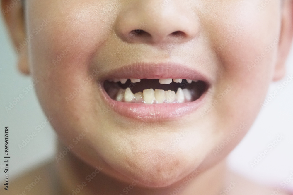 Fototapeta premium Asian boy 7 year old lost a tooth