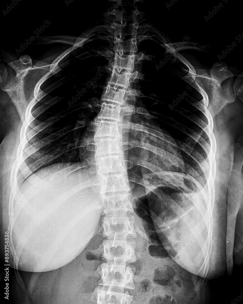 X-ray of idiopathic scoliosis of thoracic spine. Part of adolescent skeleton with spinal curvature on black background. Lateral backbone deformation. Radiological anatomy image. X-ray of idiopathic scoliosis of thoracic spine. Part of adolescent skeleton with spinal curvature on black background. Lateral backbone deformation. Radiological anatomy image.
