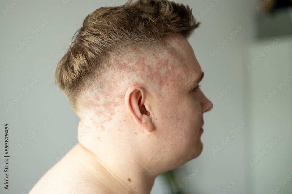 Psoriasis on the skin close-up, scalp, photos of dermatitis and eczema, skin problems concept, dermatology banner Psoriasis on the skin close-up, scalp, photos of dermatitis and eczema, skin problems concept, dermatology banner
