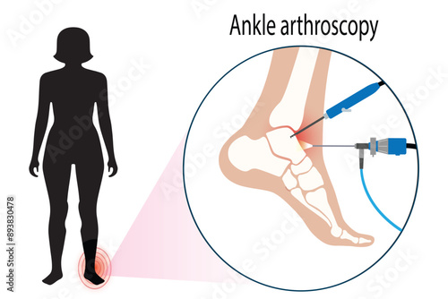 Ankle Arthroscopy Procedure: Foot Joint Surgery with Arthroscope and Arthroscopic Instrument. Treatment for Leg Pain and Inflammation. Anatomical X-ray Vector Illustration