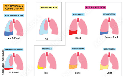 Medical Illustration of Pneumothorax and Pleural Effusion Types with Air, Blood, Serous Fluid, Pus, Chyle, and Urine in Lungs