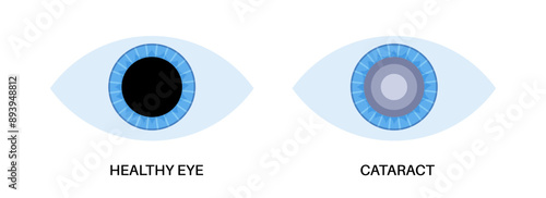 Cataract eye disease
