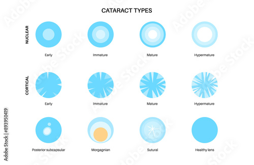 Cataract eye disease