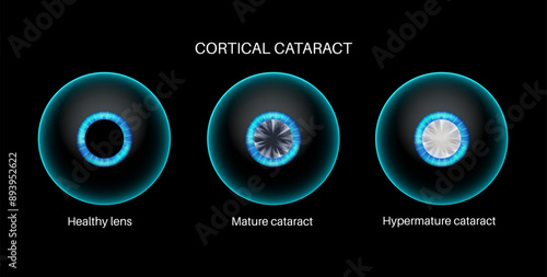 Cataract eye disease