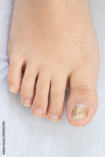 Treatment of Big Toe Nail with Onychomycosis