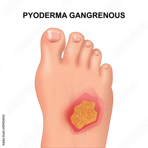 Pyoderma gangrenosum on foot illustration