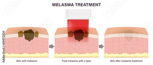 Melasma treatment with laser. Skin layers before, during and after melasma treatment with laser. Cosmetic Laser Dermatology.