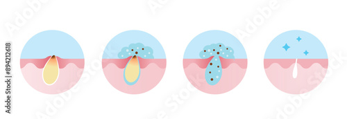Step of acne pimple treatment process vector icon set illustration. Apply salicylic acid on blackhead, penetrate into skin to dissolve the dead skin cells clogging pore and keeping pores clear.