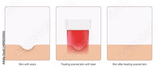 Scar treatment laser vector. Steps of before, during and after laser scar treatment. 