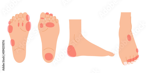 足裏と足の甲の魚の目とタコのイラストセット（女性の足）