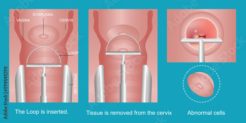 The loop electrosurgical excision procedure.