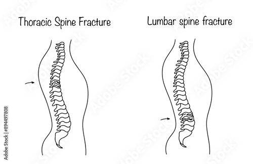 Types of spinal fracture