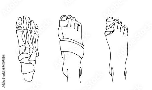 Broken toe