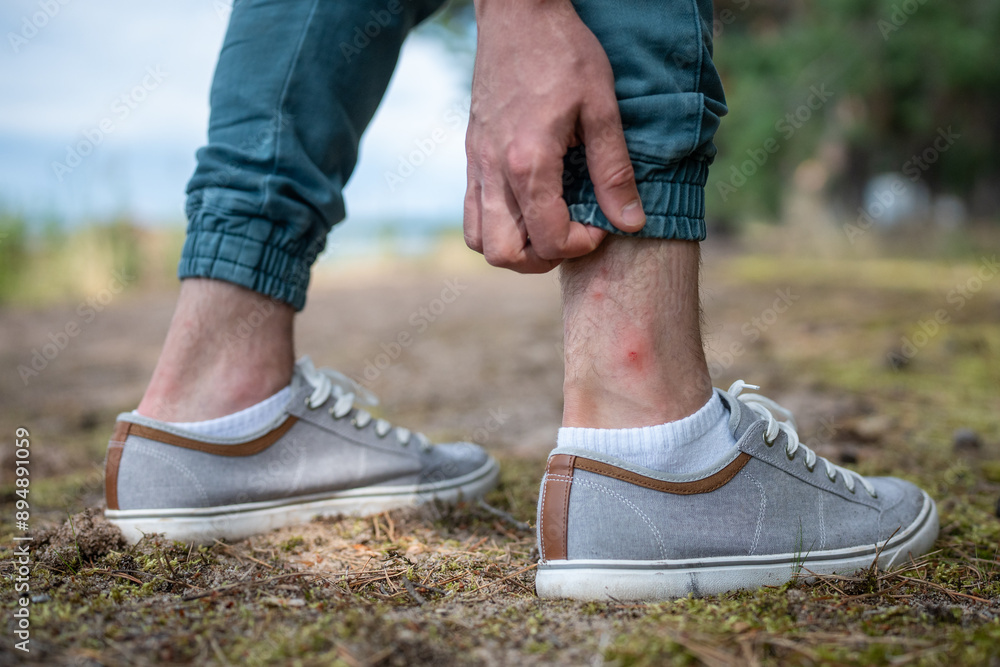 Unrecognizable man legs with allergy red wounds from insects, combs bites until they bleed. Man battles aftermath of mosquito bites, itching in bloody wounds and allergic skin reaction in nature Unrecognizable man legs with allergy red wounds from insects, combs bites until they bleed. Man battles aftermath of mosquito bites, itching in bloody wounds and allergic skin reaction in nature