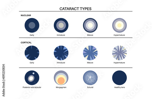 Cataract eye disease