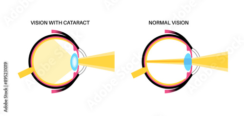 Cataract eye disease