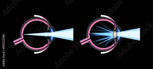 Cataract eye disease