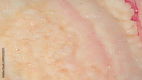 The fat tissue is shown gradually decreasing in volume indicating successful and consistent fat burning. photo