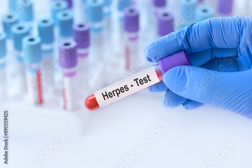 Doctor holding a test blood sample tube with herpes virus test on the background of medical test tubes with analyzes