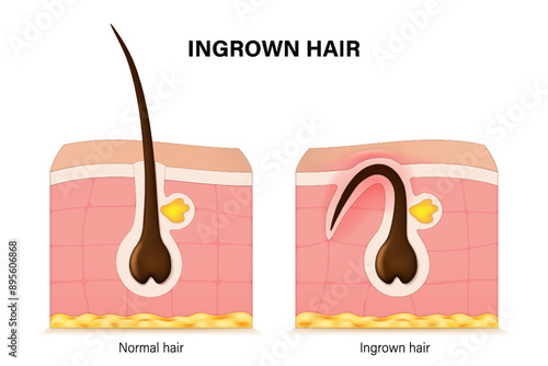Normal and Ingrown hair. Structure of human hair follicle. Ingrown hair skin inflammation.