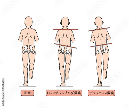 トレンデレンブルグ徴候とデュシエンヌ徴候（文字あり）